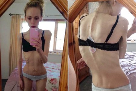 Бриджит малкольм анорексия