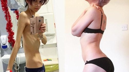 Девушка с анорексией