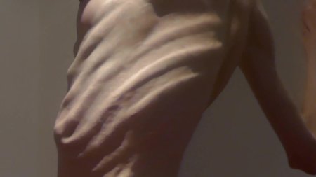 Анорексичная кахексия