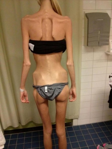 Очень худая женщина