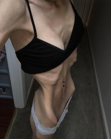 Худая девушка анорексия