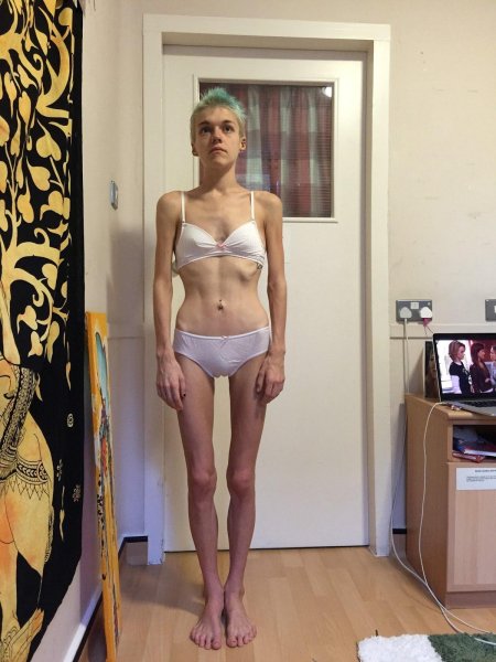 Хилькевич анна анорексия