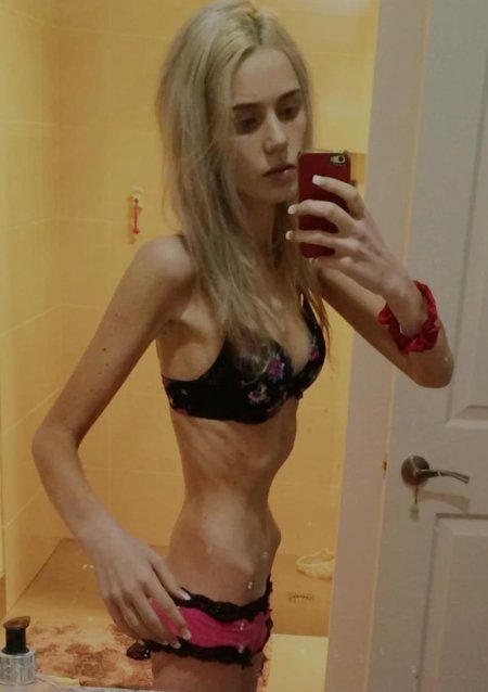 Анорексичка мишель алессандро