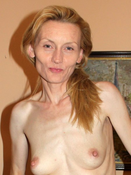 Анорексичная кахексия