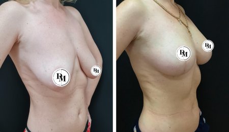 Грудь подтяжка