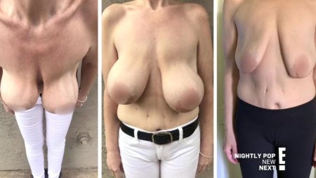 Пластика груди