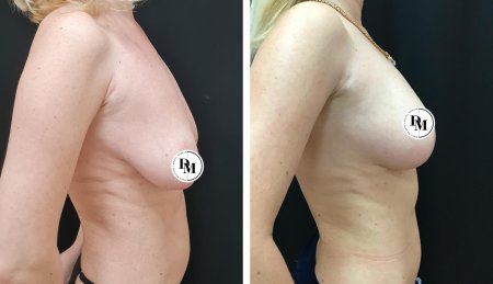 Грудь подтяжка